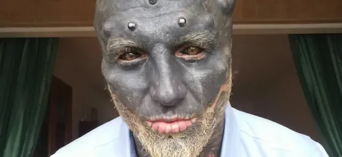 Après les oreilles, le Français « Black Alien » se fait retirer le...