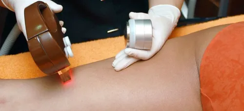 Elle ressort gravement brûlée d’une séance d’épilation définitive à...