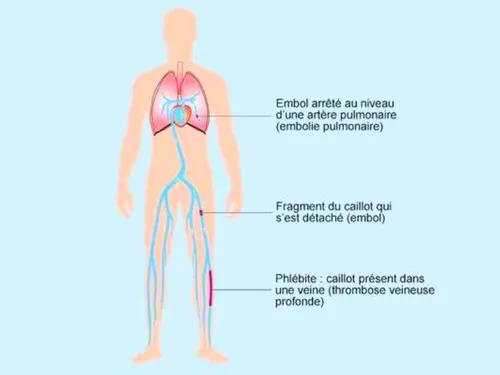 L'Eure-et-Loir un peu plus concerné par les embolies pulmonaires