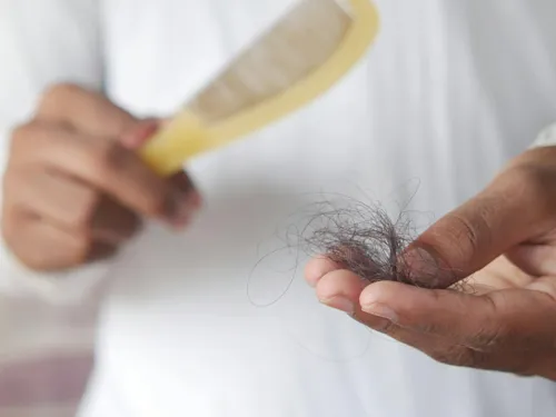 Calvitie : une simple ordonnance ne suffit plus pour obtenir le...