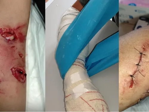 Fourmies : un enfant grièvement blessé après avoir été mordu par un...