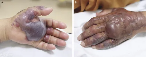 Il se fait amputer d’un avant-bras après la consommation de fruits...