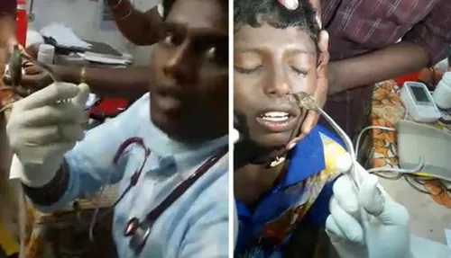 Il retire un poisson vivant de la narine d'un enfant