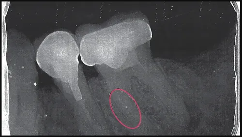 15 ans après, il découvre que son dentiste a oublié une aiguille...