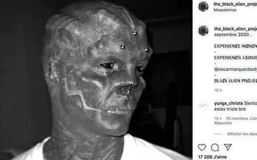 Après les oreilles, le Montpelliérain "Black Alien" se fait retirer...