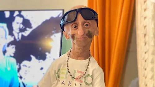 Rania, adolescente star de Youtube et TikTok, atteinte de progéria,...