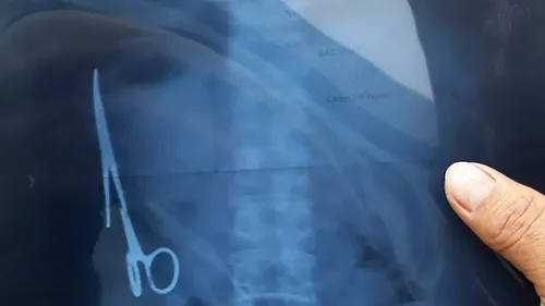 Elle vivait depuis 20 ans avec une paire de ciseaux chirurgicaux...