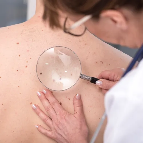 La pénurie de dermatologues continue de s’aggraver en France