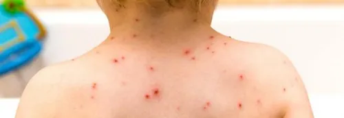 Journal 17h - La varicelle fait un tabac, dans le Nord et le Pas de...