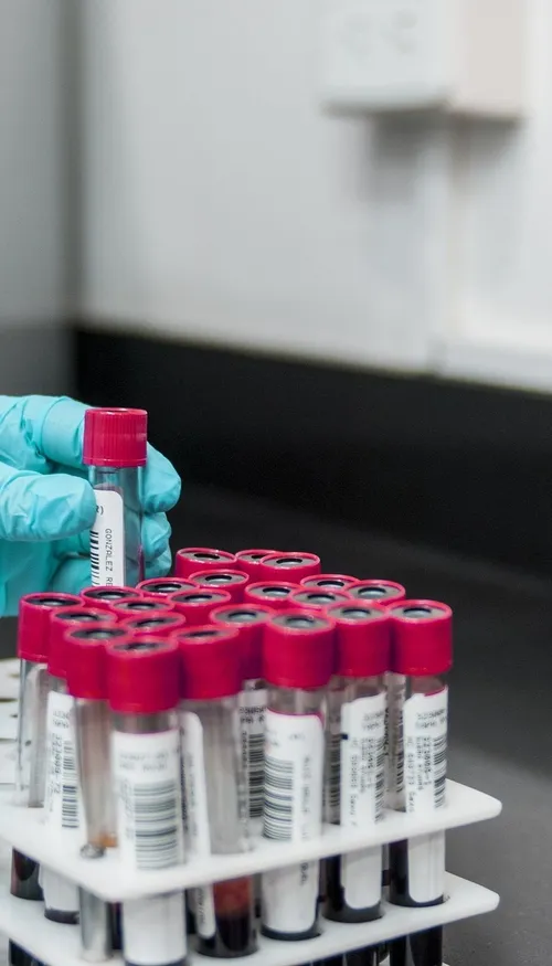 Un test sanguin pour détecter la maladie de Parkinson